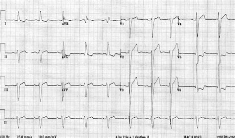 lv strain adalah|Left Ventricular Hypertrophy (LVH) • LITFL • ECG Library Diagnosis.